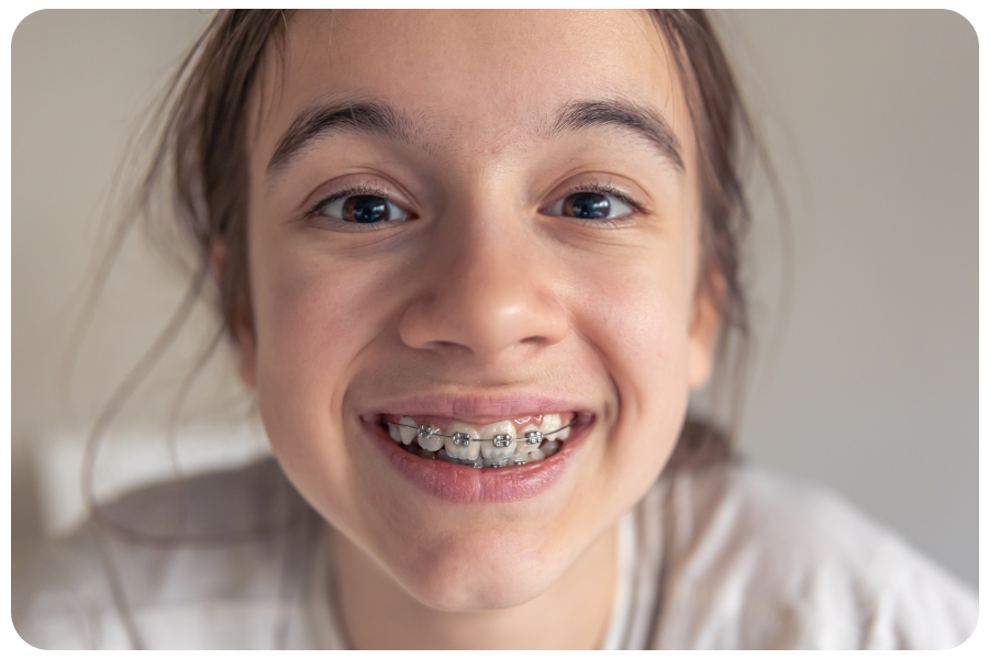 The Comprehensive Guide to Braces: Everything You Need to Know