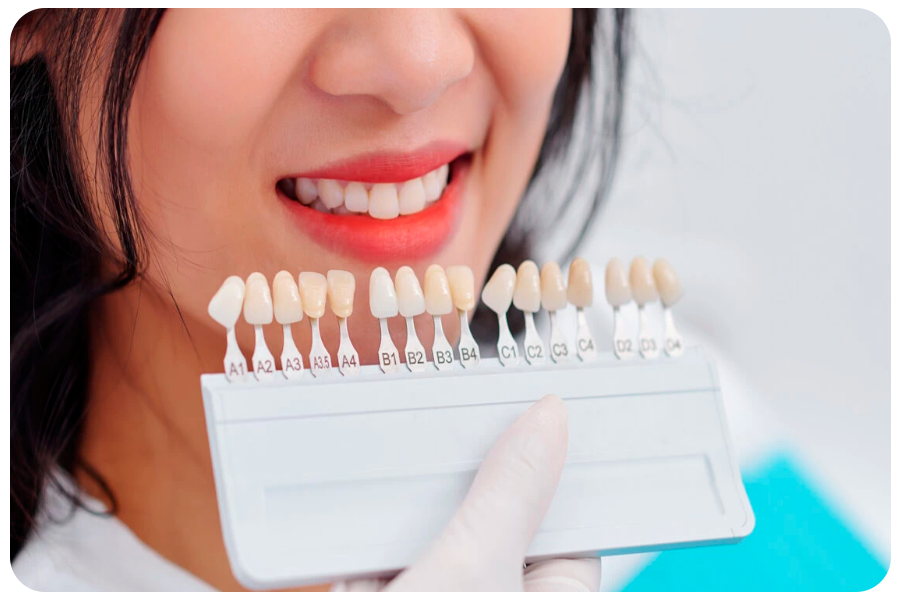 Everything You Need to Know About Dental Veneers